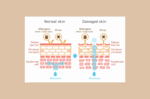 seborroisch_eczeem_voeding